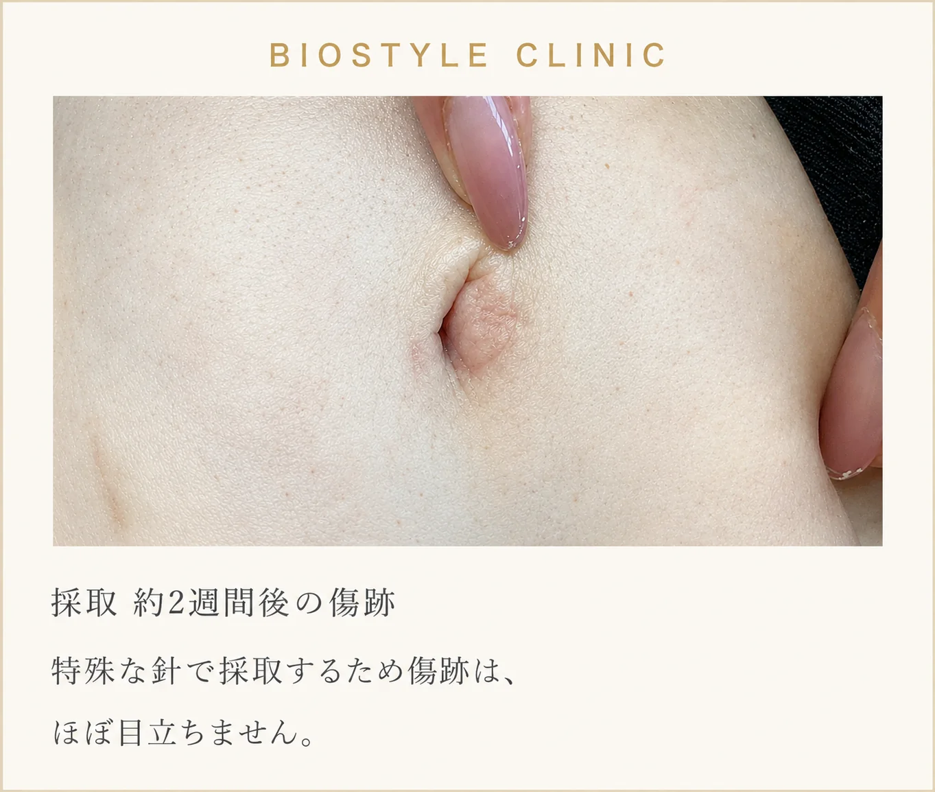 BiOSTYLE CLINIC：採取約2週間後の傷跡。特殊な針で採取するためほぼ目立ちません。