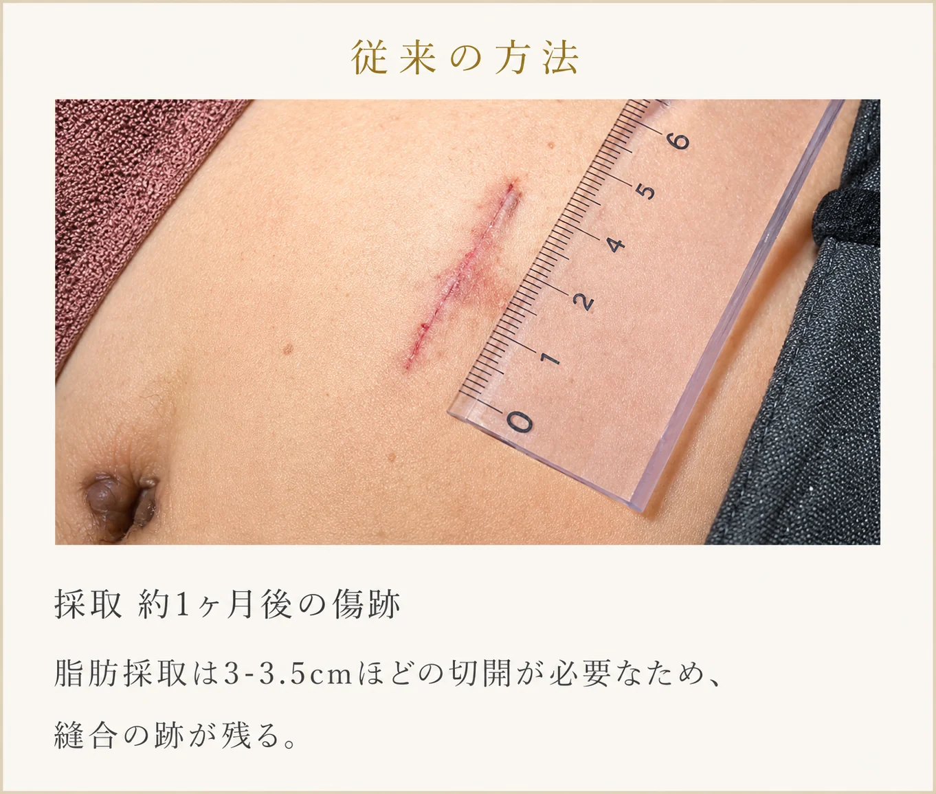 従来の方法：採取約1ヶ月後の傷跡。約3〜3.5cmの切開が必要なため縫合の跡が残ります。
