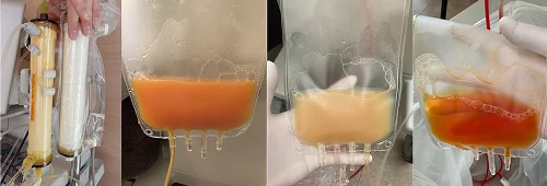 フィルターの使用前後(除去された病因物質により濁った血漿の変化)